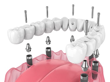 Dental implant Home page thumbnail-min