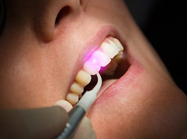 Laser Dentistry Home page thumbnail-min