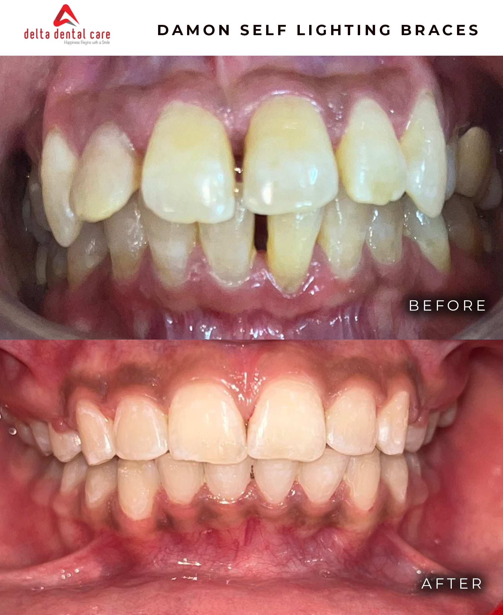 Before and After