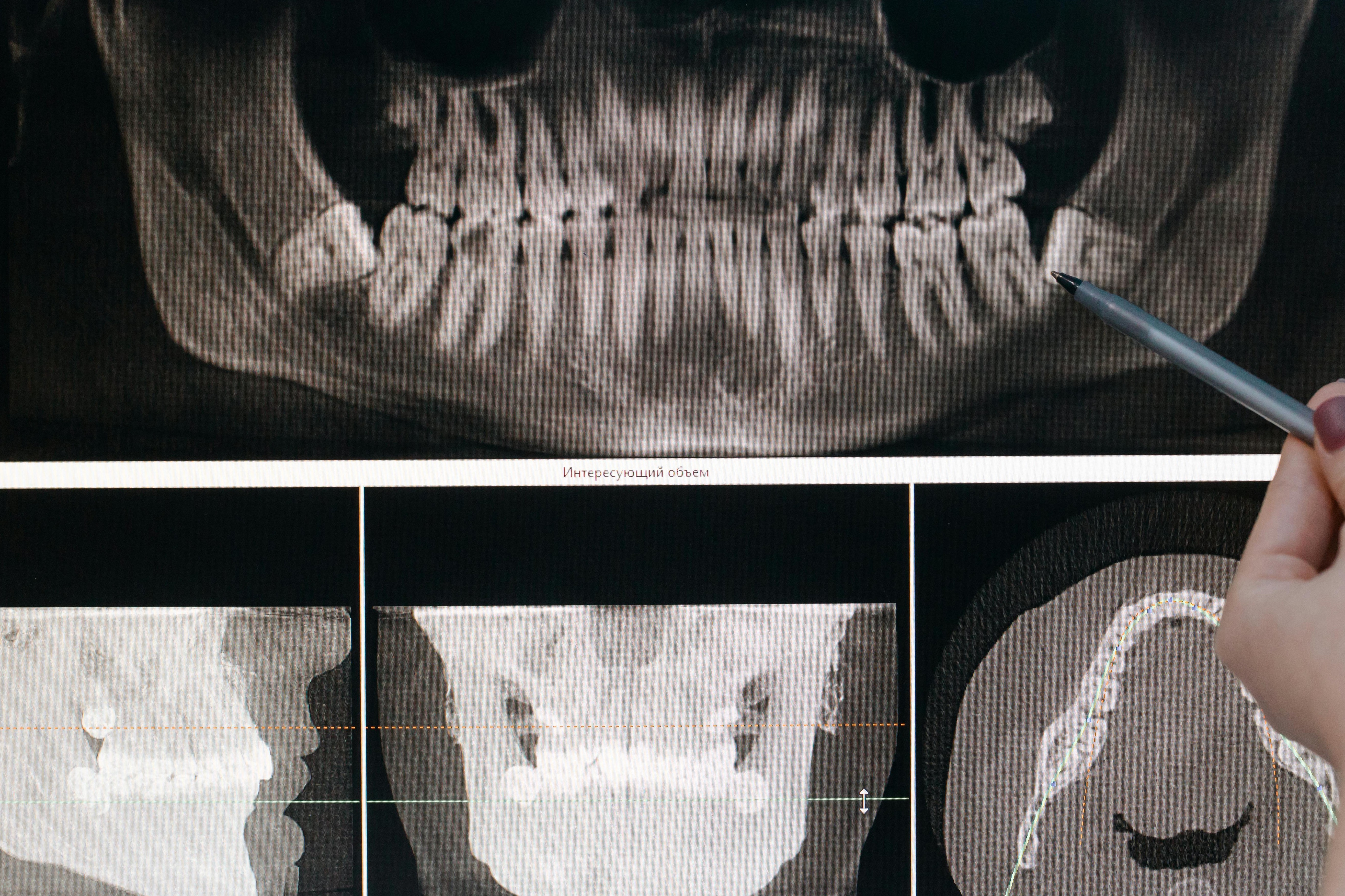 Tooth Aligners
