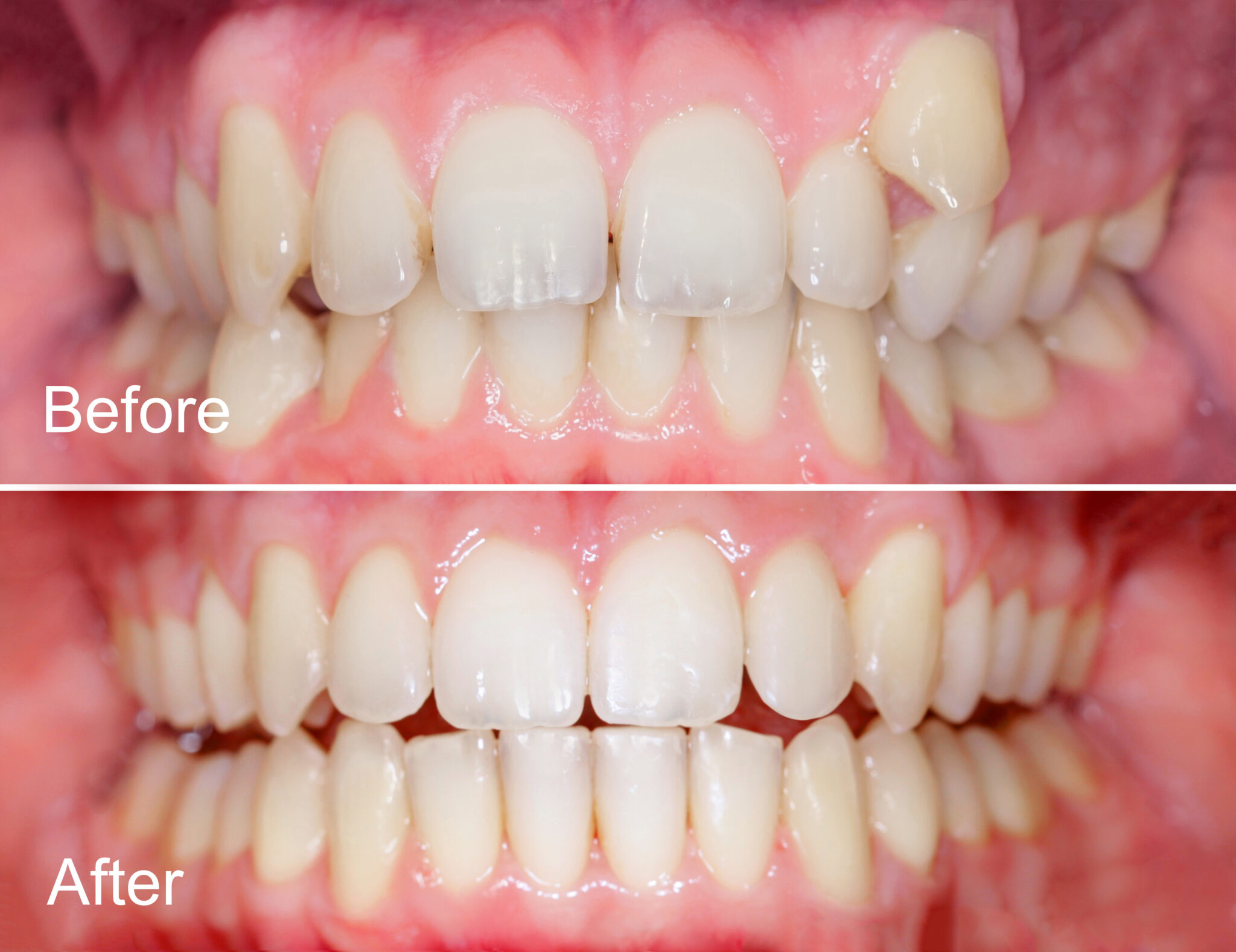 Before and After