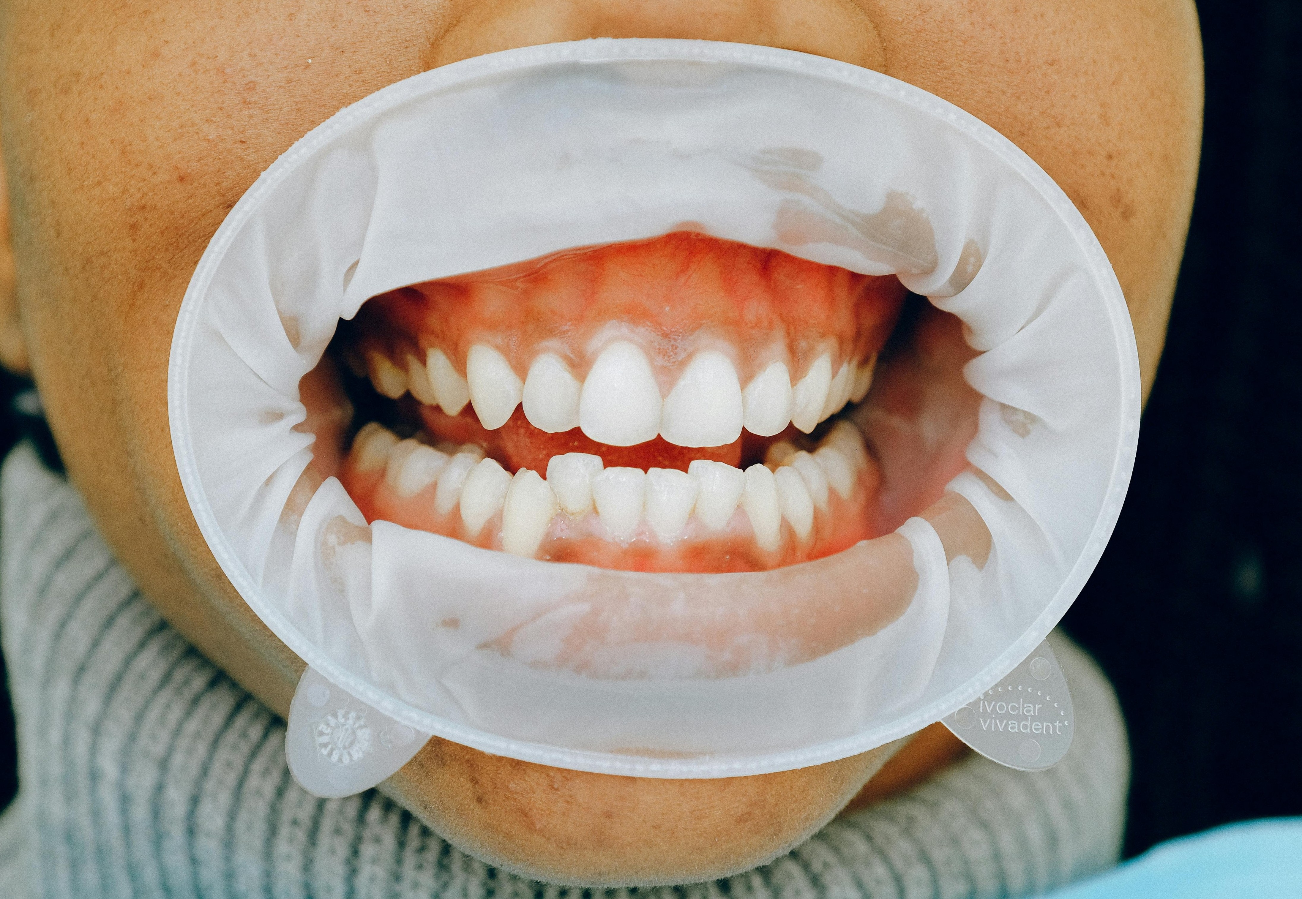 Gum Treatment