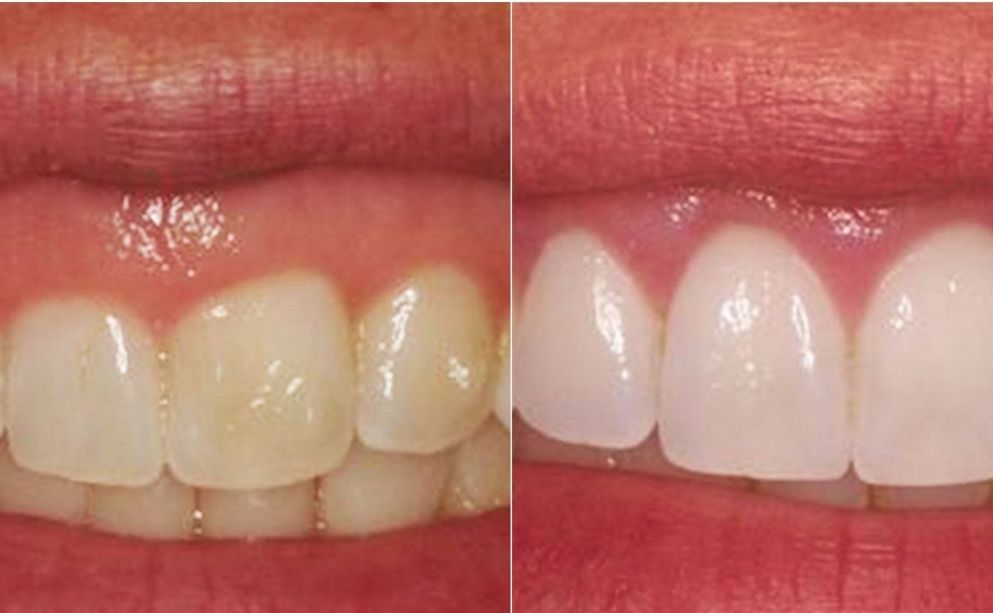 Gum Treatment