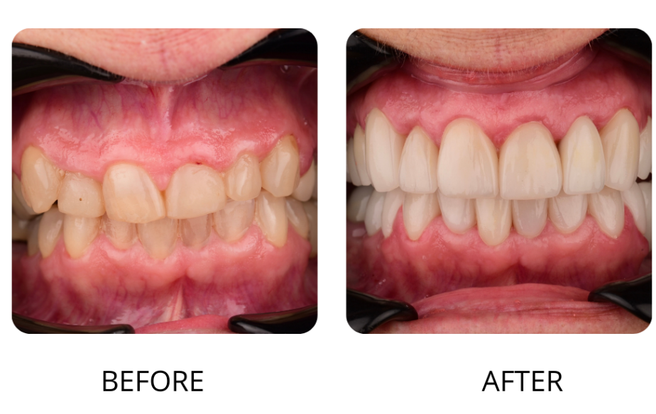 Laser Dentistry