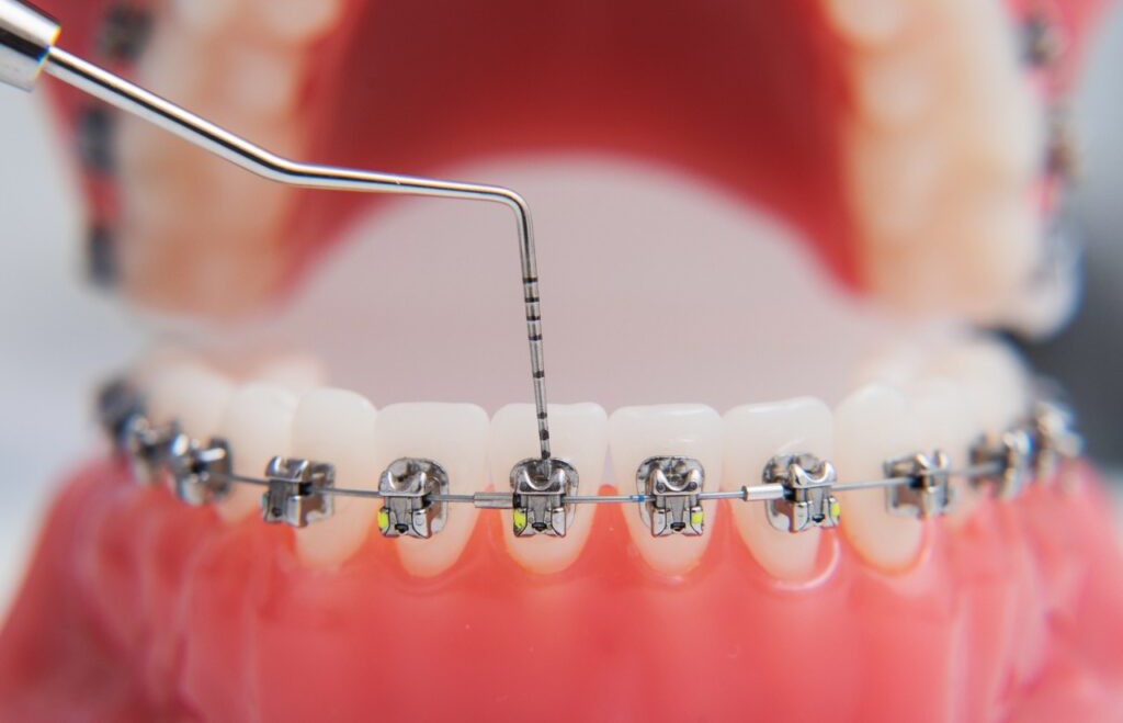 Orthodontic Treatment