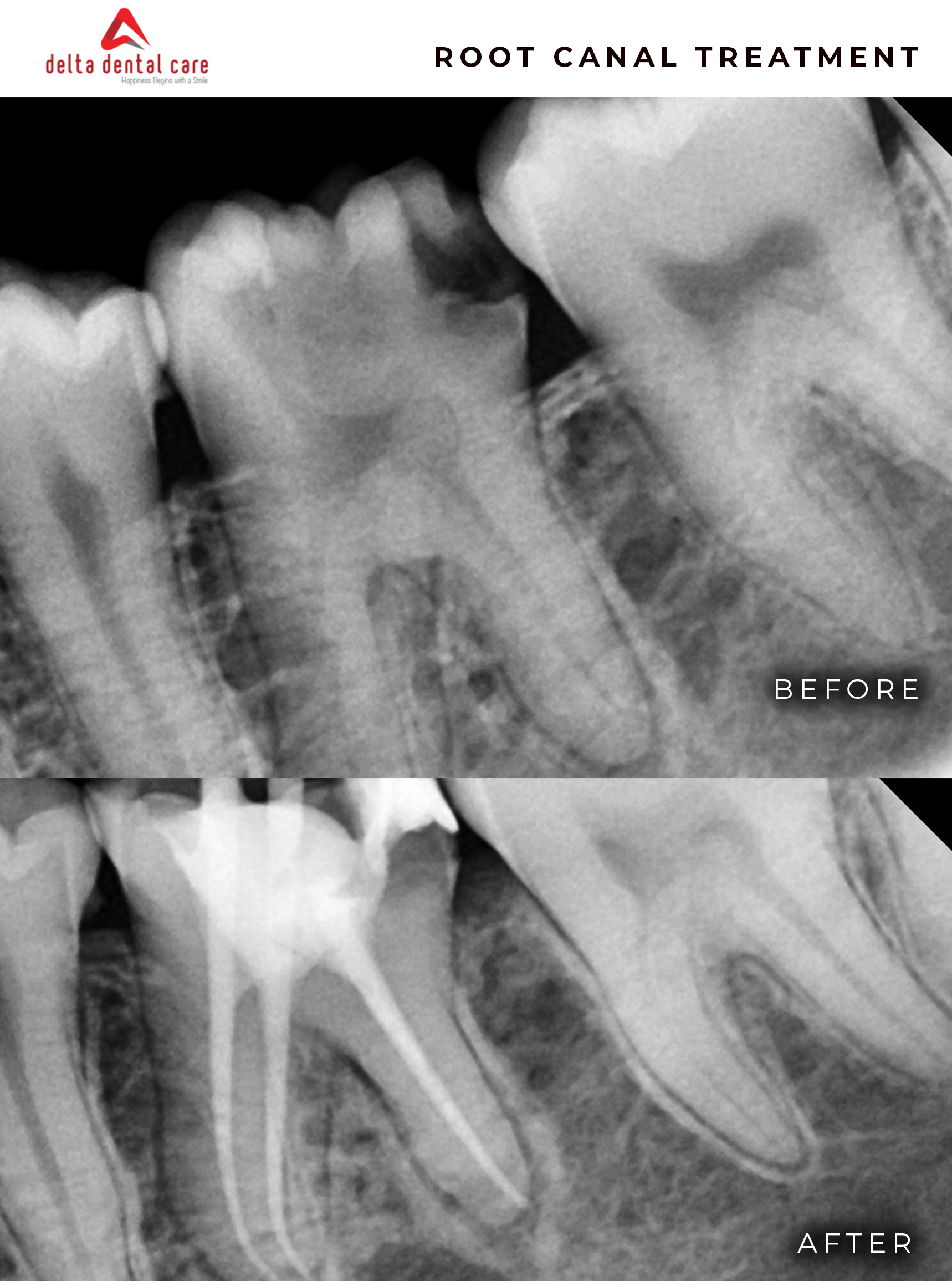 Before and After