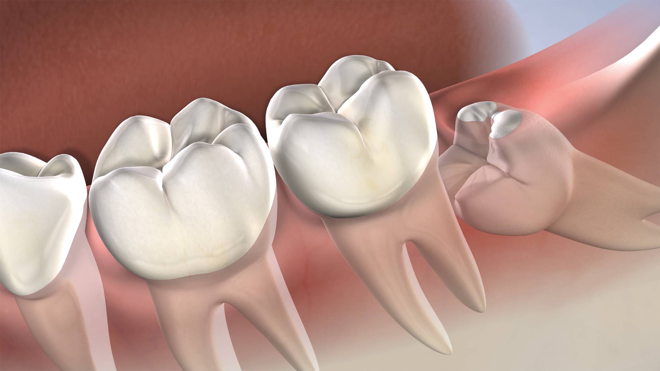 Wisdom Tooth Surgery